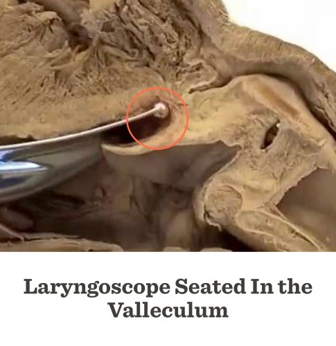 This is your goal. Think Valleculoscopy not Laryngoscopy.