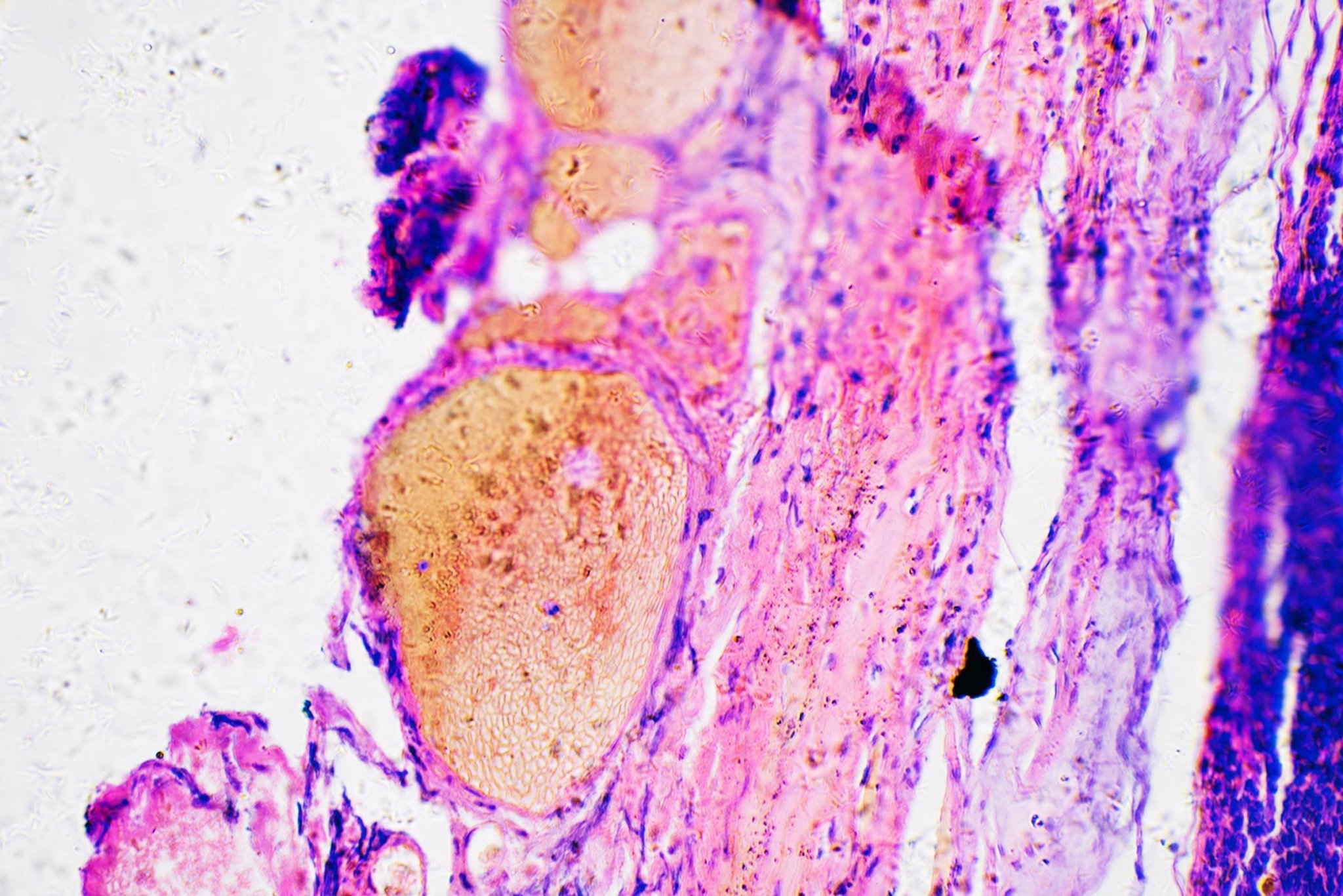 “Here’s How I Knew I Had Melanoma”