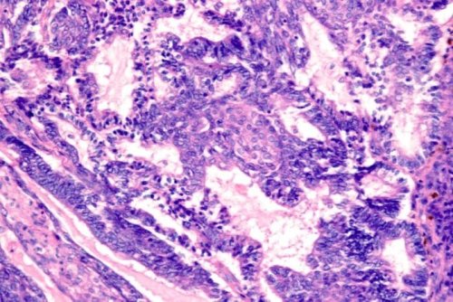 "Here's How I Knew I Had Ovarian Cancer”