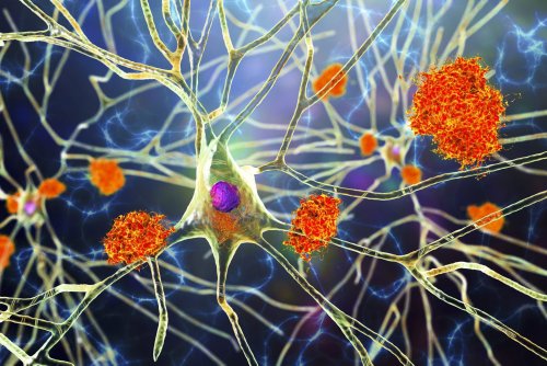 Fears About Alzheimer's That Experts Say Aren't Founded