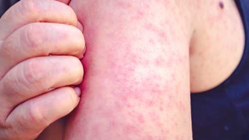 Amid measles outbreak in South Florida in Broward, another infection emerged in Central Florida