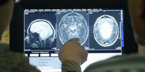 Alzheimer: Rätsel um absterbende Hirnzellen gelöst