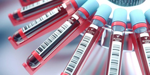 Früherkennung: Biomarker für Long Covid identifziert
