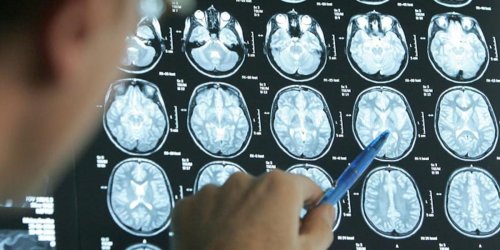 Immer mehr junge Patienten: Schlaganfall unter 50 Jahren: Warum es schlanke und sportliche Personen trifft