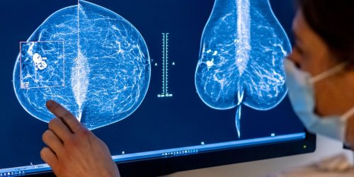 Gesundheit: Brustkrebsfrüherkennung wird von weniger Frauen genutzt