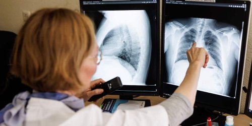 RKI meldet: Tuberkulose-Fallzahlen in Deutschland gestiegen – das sind die Symptome