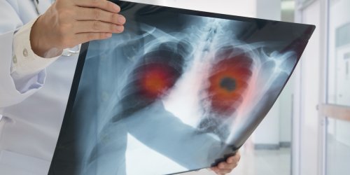 Anti-Krebs-Kodex: Das sind die 10 goldenen Regeln, mit denen Sie Ihr Krebsrisiko minimieren