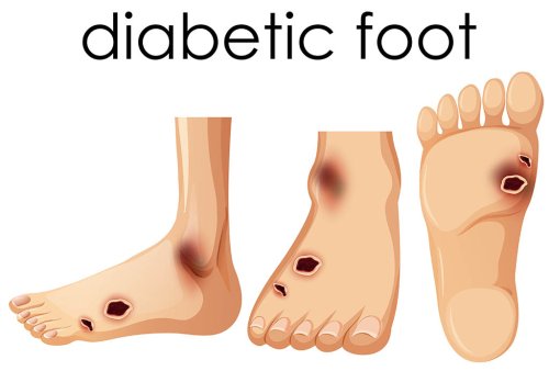 Signs of Diabetic Foot Symptoms You Should Know
