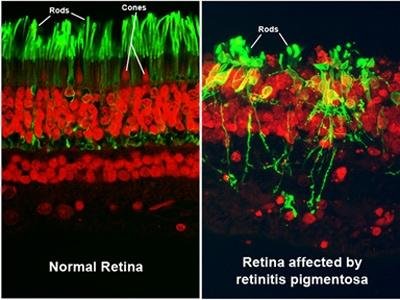 The Power Of Precision Medicine: Hydrogel-Based Therapy For Retinitis Pigmentosa