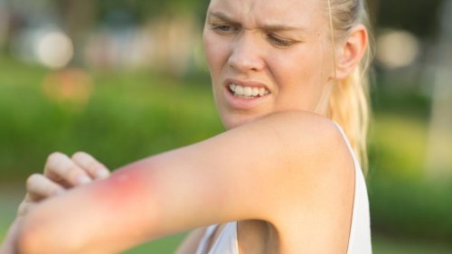 How To Identify And Treat Bug Bites Flipboard