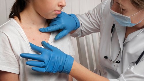 Another state confirms measles case with infected child its first of year