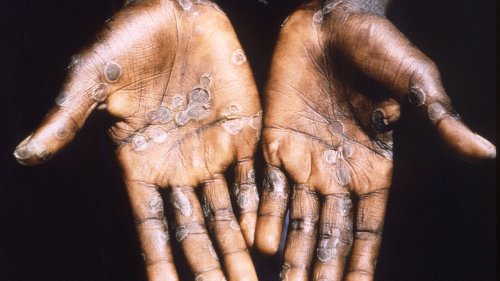 US monkeypox cases climb, another reported in Colorado