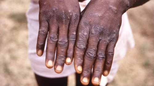 Monkeypox: CDC investigating first US case of the year as growing clusters emerge globally outside Africa