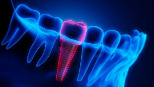 AI in dentistry: Researchers find that artificial intelligence can create better dental crowns