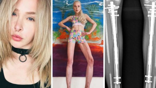 Über 100.000 Euro und Höllen-Schmerzen: GNTM-Model Theresia Fischer lässt Beine um 14 cm verlängern