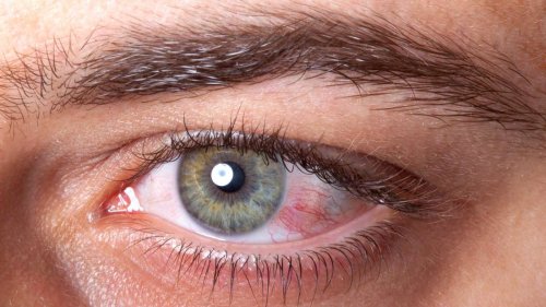 Allergiesymptome: Schlecht Sehen kann auch auf Entzündung oder Glaukom hindeuten