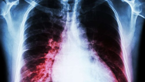 Herzinfarkt-Risiko früh erkennen: Kardiologe warnt vor „stillen Killern“