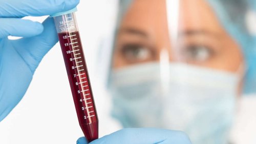 Studie weckt Hoffnung: Neues Bluttest-Verfahren erkennt Demenz bis zu 15 Jahren früher