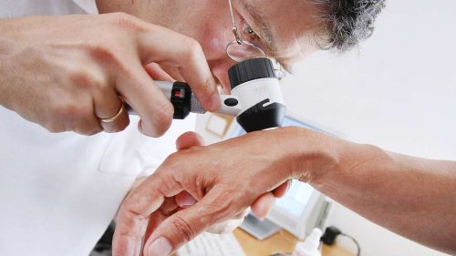 Aktueller Report liefert alarmierende Hautkrebszahlen: Eine Generation ist besonders gefährdet