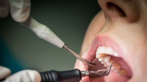 Versicherung: Zahnreinigungs-Zuschuss nicht in jeder Praxis