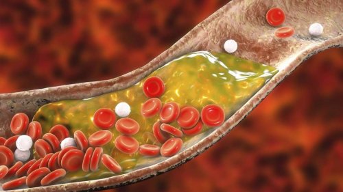 Cholesterin senken: Darmmikrobiom im Gleichgewicht schützt vor Schlaganfall