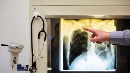 Neuinfektionen erreichen Höchststand: Tödliche Lungenkrankheit wieder auf dem Vormarsch