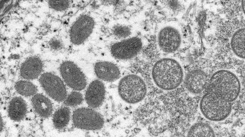 L'Europe et l'Amérique du Nord font état de premiers cas de variole du singe