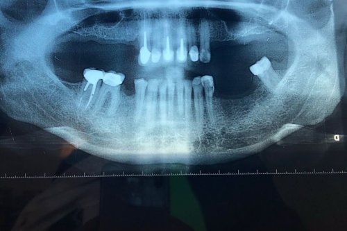 "En une séance, le dentiste m’a enlevé toutes les dents du haut, il m’a laissé seulement six dents", une plainte déposée contre les cabinets dentaires low-cost Dentexia