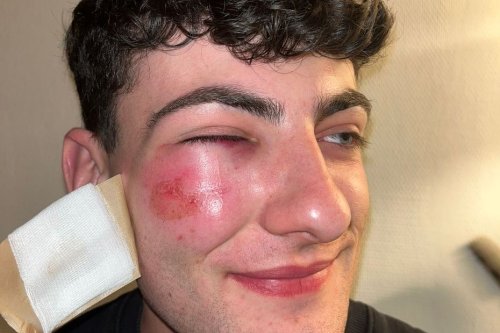 TÉMOIGNAGE. Violences entre policiers et manifestants : "à 2 cm près, je perdais mon œil" raconte Clément