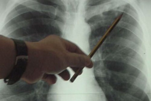 Tuberculose: 56 nouveaux cas et 3 décès en 2022