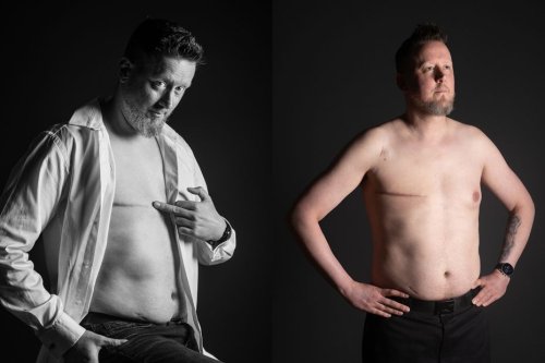 Témoignage. Atteint d'un cancer du sein, il pose dans un calendrier pour sensibiliser les hommes : "heureusement que j'en ai parlé"