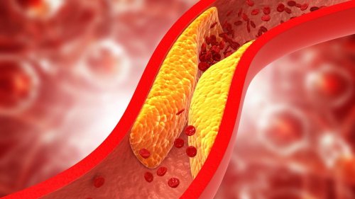 Cholesterin: LDL- oder HDL – Das sagen die beiden Werte aus