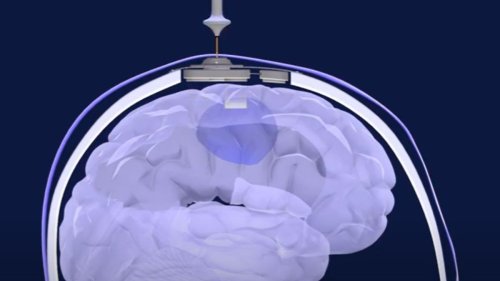 New ultrasound device helps powerful chemo reach deadly brain cancers, human trial shows