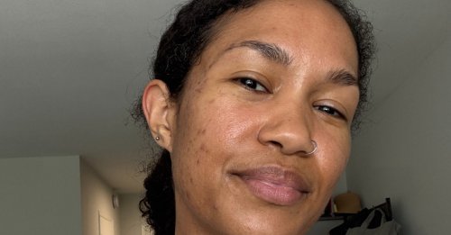 This New High-Tech Zit Zapper Cleared My Acne in Two Weeks Flat