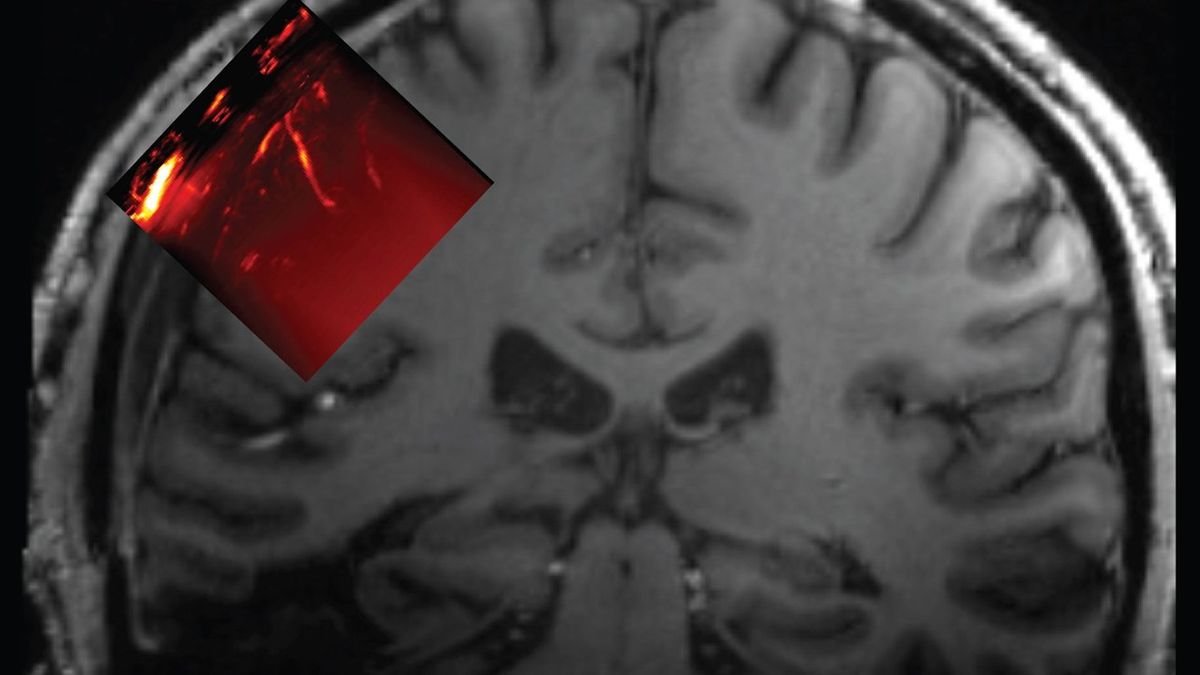 Scientists inserted a window in a man's skull to read his brain with ultrasound