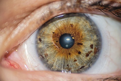 Doctors Say Injecting Gold Into Eyeballs Could Restore Lost Vision