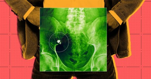 Meet the Man Who Got a High-Tech PillCam Stuck Inside His Intestines for Six Months — and Says It Saved His Life