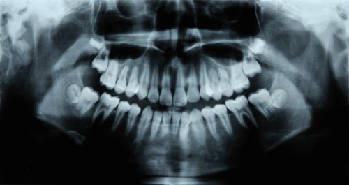 Scientists Have Discovered a Drug That Fixes Cavities and Regrows Teeth