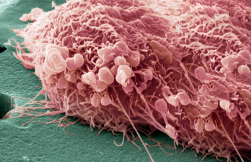 Researchers Uncover What Causes Cancer Cells to Spread and How We Can Slow It