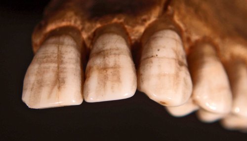 Teeth track gender bias back over 1,000 years