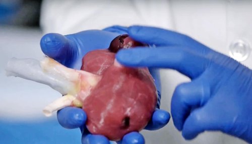 Model organs let surgeon rehearse ‘impossible’ surgery