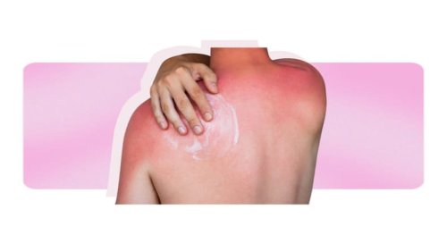 how-long-does-a-sunburn-last-and-what-to-do-if-you-get-one-flipboard