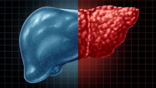 Fatty liver disease is a serious problem. Here's who should be worried about it.