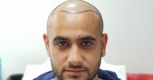 Acklam businessman's new-found confidence after brother's taunts led to hair transplant in Turkey