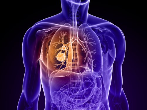 Oral Microbiome Diversity and Species Abundance Linked to Lung Cancer in Nonsmokers