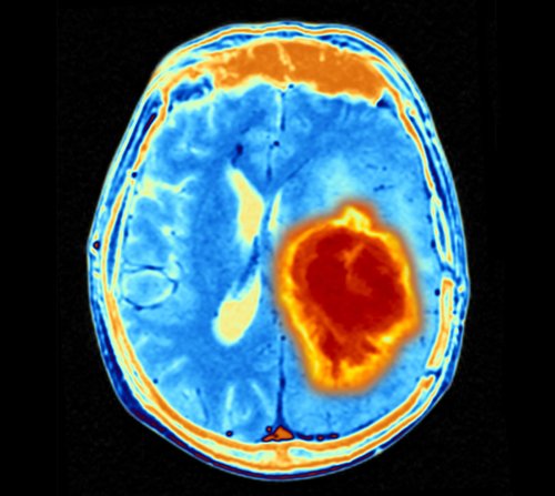 Novel Barrier That Impedes Glioblastoma Response to Chemotherapy Uncovered