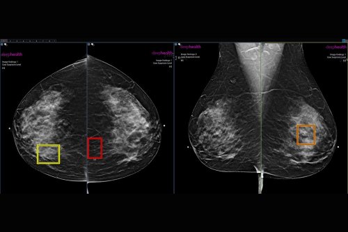 AI Is Detecting More Breast Cancer Cases, Study Suggests