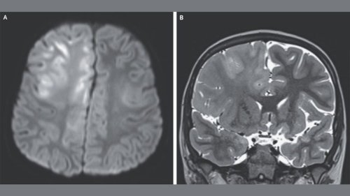 This Is What a Brain Destroyed by Measles Looks Like | Flipboard