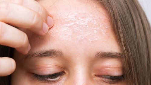 Why The Skin On Your Forehead May Be Flaking - Glam