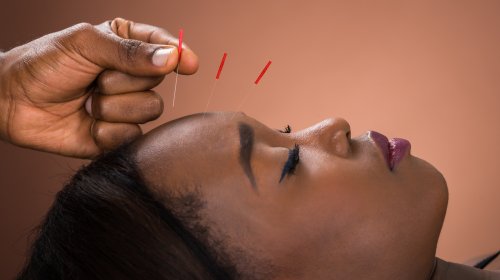 Is Cosmetic Acupuncture Right For You? - Glam